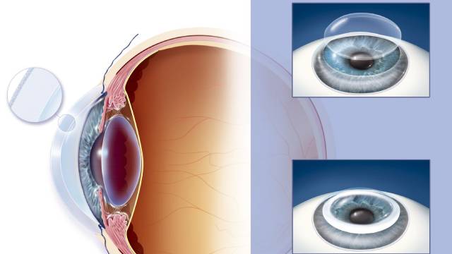 Cornea of Eye